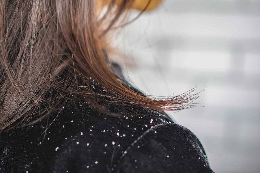 7 Everyday Triggers Making Your Scalp Dermatitis Worse