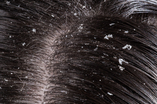 Dandruff Myths & Realities: What Works in Singapore's Humidity
