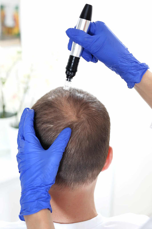 A Guide to Preparing for a Hair Loss Microneedling Treatment
