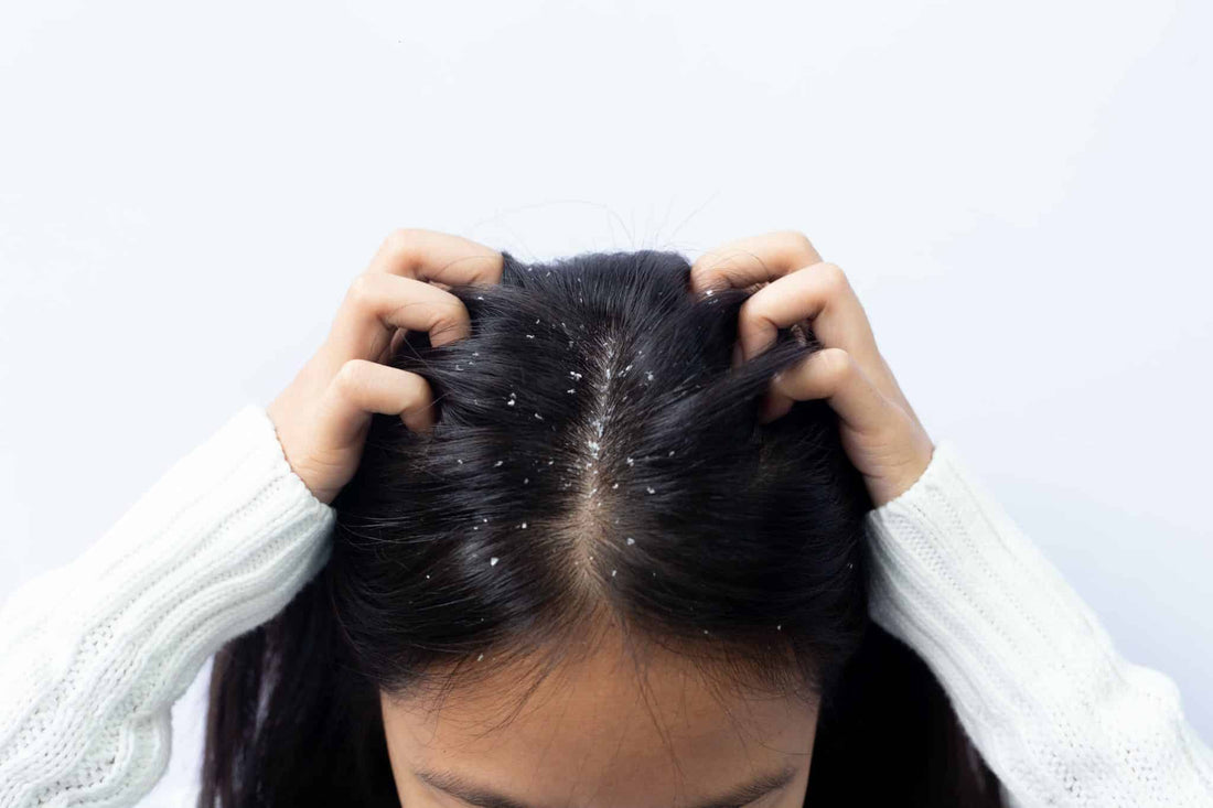 When Should You See a Specialist For Your Dandruff? - TrichoLab