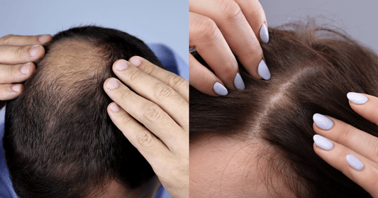 Male vs Female Hair Loss: Differences & Treatment Options