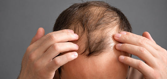 Saw Palmetto vs Minoxidil for Hair Loss: Which Works Better?