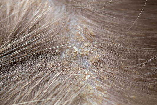 Is It Dandruff or Not? Understanding Scalp Dermatitis