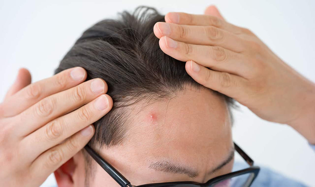 Scalp pimples: Causes and treatment