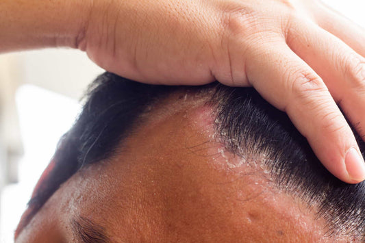 How to manage seborrheic dermatitis naturally