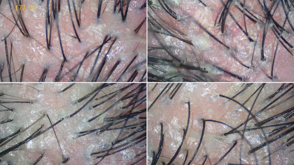 Scalp Seborrheic Dermatitis (Eczema) Treatment Singapore
