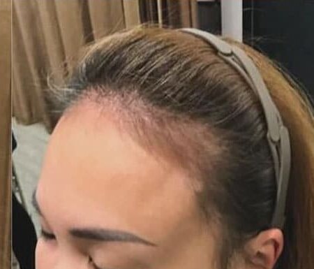 Hairline showing regrowth after microneedling with IYASHI exosomes