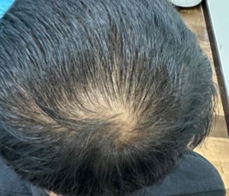 Crown with visible thinning before microneedling with IYASHI exosomes